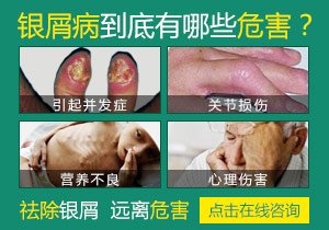 春天来临,莫让头部牛皮癣“牛”起来.jpg